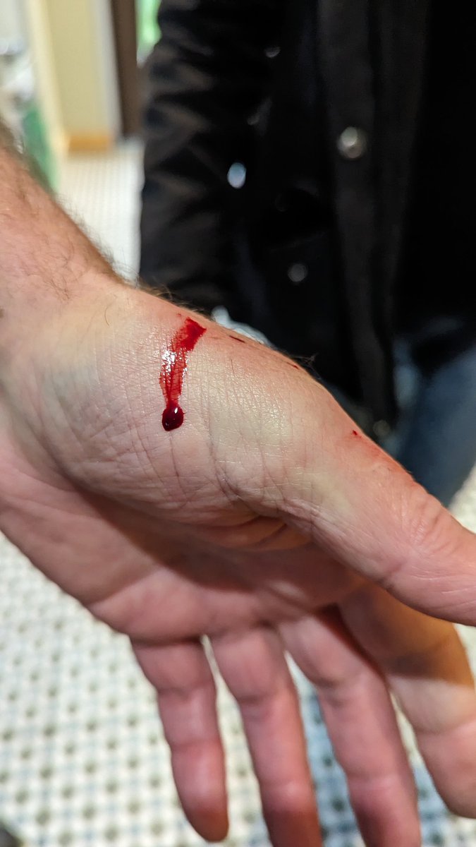 41Wintr's tweet photo. @johnlewishelp My oven door has exploded cutting my father's hand. I am being told this is normal wear and tear as oven is out of warranty. I don't think is normal? https://t.co/X2YpsfQ72a