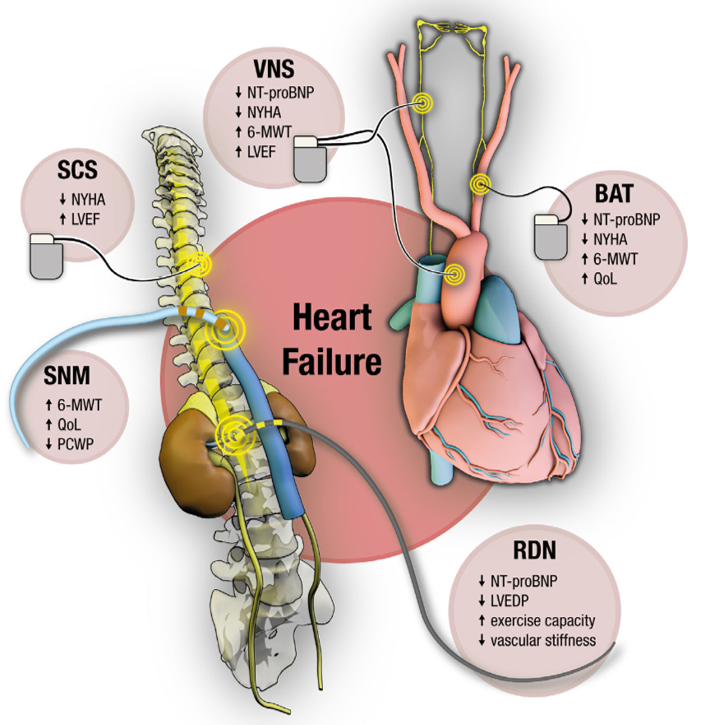 What is the role of #neuromodulation in #heartfailure 🤔❓ 👉potential clinical benefits and evidence. Check our review @ESC_Journals #EJHF doi:10.1002/ejhf.3147 @FudimMarat @FelixMahfoud @LucasLauder @HanCardiomd @JBauersachsMD #UKScardio @HFA_President #Cardiotwitter