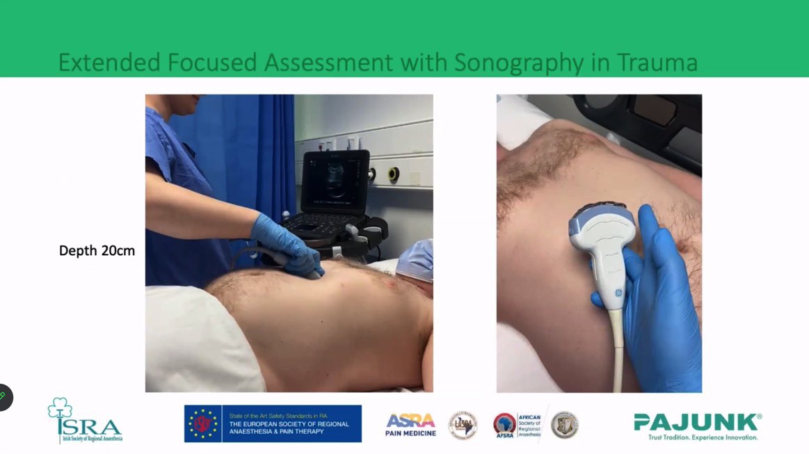 Excellent POCUS presentation from Dr Lua Rahmani for the Irish webinar #WDRAPM Mater team leading the way on regional anaesthesia and trauma