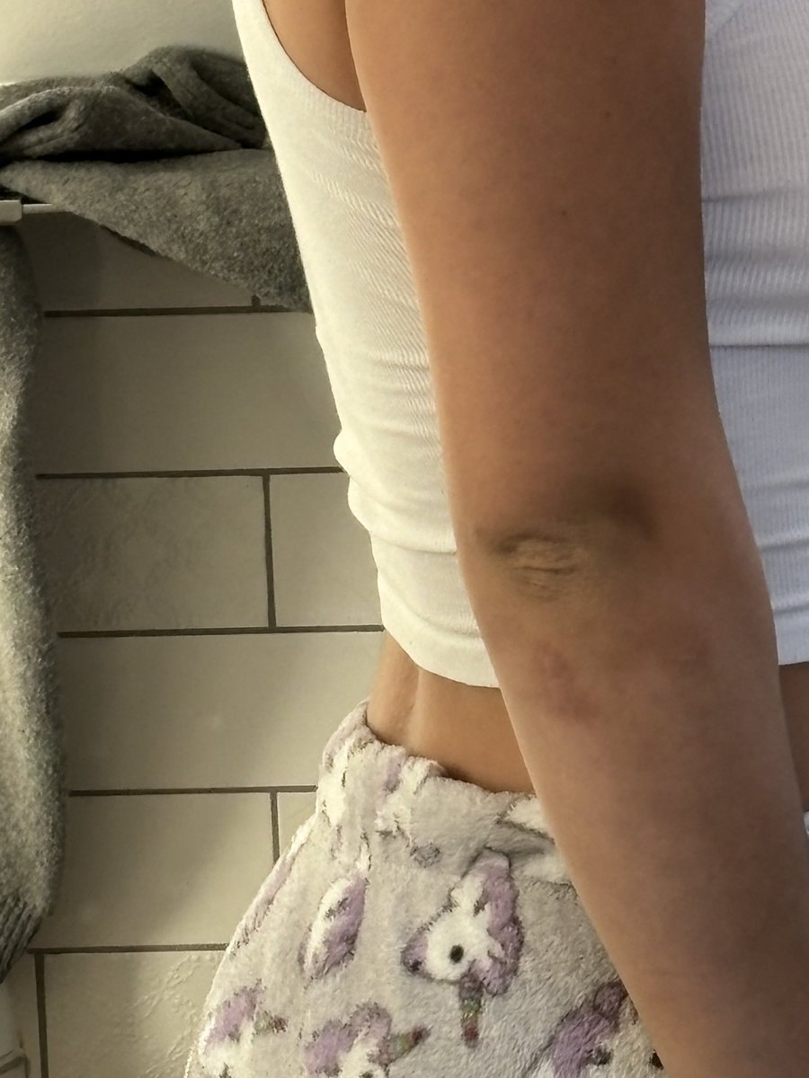 a faszki attol, hogy minden hb utan gele vagyok hegekkel mer ateltem ejjel a 2 vilaghaborut