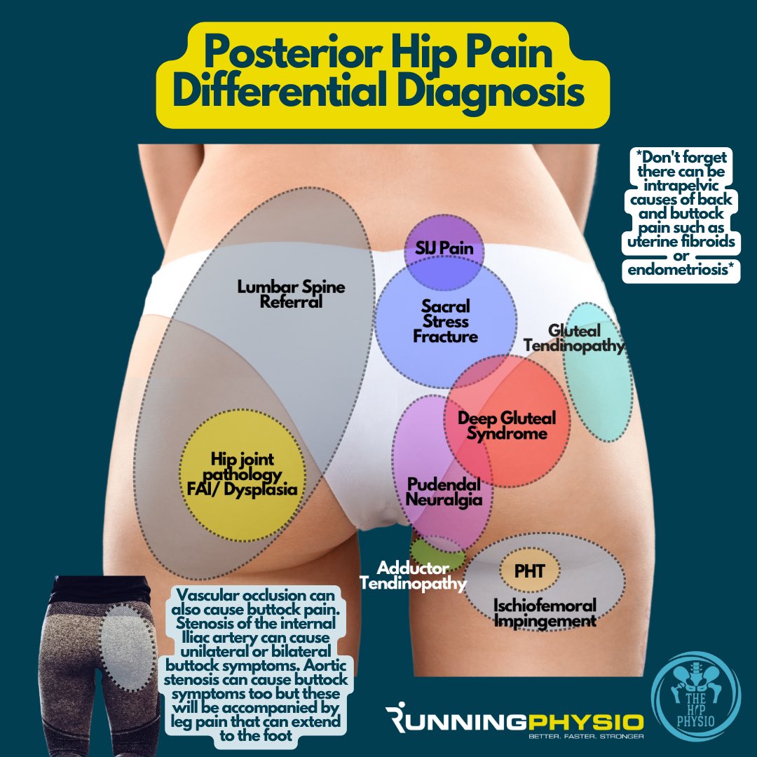 Running-Physio (@tomgoom) on Twitter photo Posterior hip pain differential diagnosis
This is a complex area so I teamed up with <a href="/TheHipPhysio/">Mehmet Gem | The Hip Physio</a> to create this.
Thanks to <a href="/TaylorAlanJ/">Alan J Taylor</a> for his feedback to improve the section on vascular symptoms.
Please note pain locations are approximately & will vary between individuals Posterior hip pain differential diagnosis
This is a complex area so I teamed up with <a href="/TheHipPhysio/">Mehmet Gem | The Hip Physio</a> to create this.
Thanks to <a href="/TaylorAlanJ/">Alan J Taylor</a> for his feedback to improve the section on vascular symptoms.
Please note pain locations are approximately & will vary between individuals