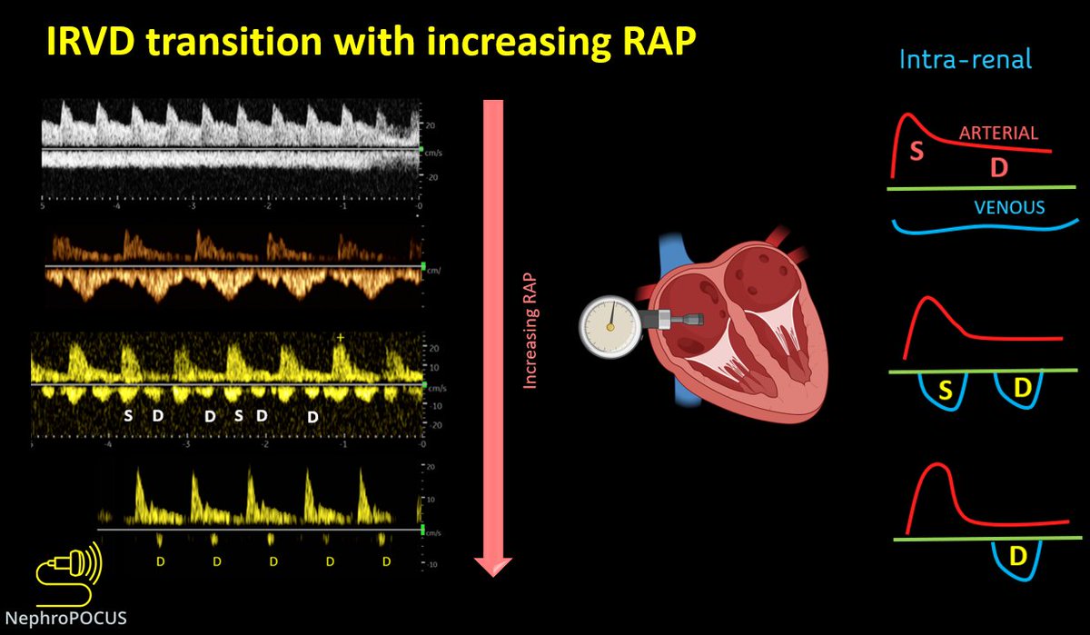 It's always a delight to be part of the @ASARUC1 course and share the stage with @hepocus Thanks to @panchopocus and team. #POCUS #Nephrology #MedEd