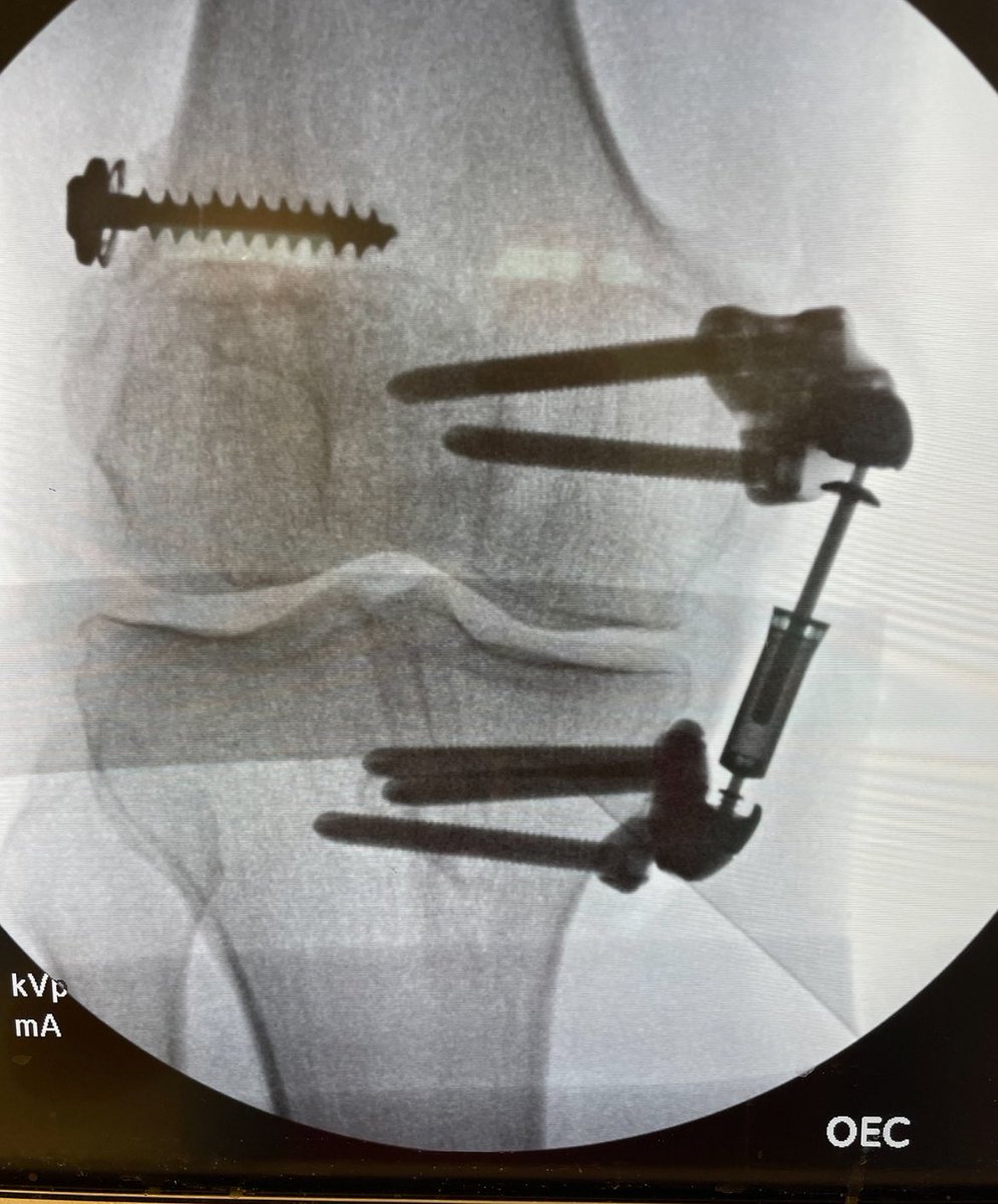 📣 Still excited to offer #MISHA to my patients w/ medial knee arthritis pain. First patient in Northern California implanted w/ MISHA at 5 weeks post op @UCDavisOrtho and @UCDavisHealth keep our patients moving. @Moximed #orthotwitter #jointpreservation