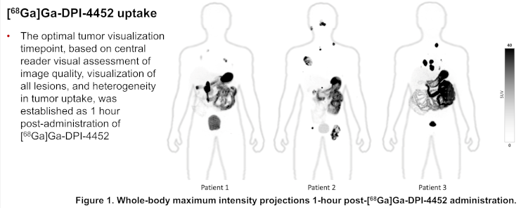DrMHofman's tweet photo. First 3 patients with clear cell renal carcinoma imaged with Ga-68 DPI-4452 @PeterMacCC: PEPTIDE targeting carbonic anhydrase 9. SUVmax in tumour over 100 in all patients (unselected). Presented today #GU24 @ASCO @gu_onc @DrBenTran @DrDarrenFeldman @MHaskali 

Next step is Lu-177 DPI-4452 for therapy...