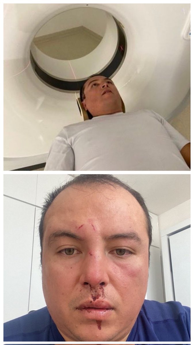catrina_nortena's tweet image. 🚨 El Señor que fue Golpeado cuando caminaba con su perro por los Guaruras de @SandraCuevas_ es @robernoricumbo 

Ayer tuvo que tomarse una tomografía por los fuertes dolores de cabeza que le provocan mareos y no lo dejan dormir.

Les pido su RT para que la @FiscaliaCDMX,…