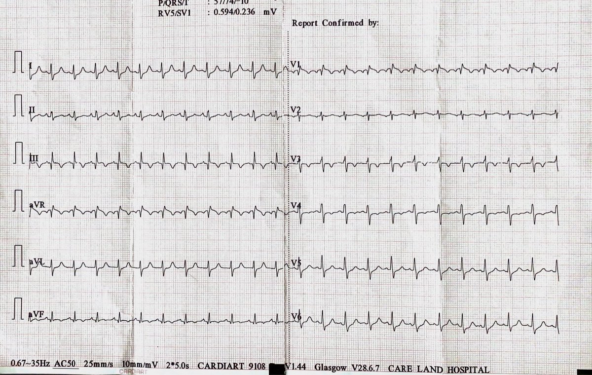 DrRajeshG1's tweet photo. ECG for residents. A 40 year old heathy male with no past medical illness admitted with syncope after returning home from football tournament. His BP on admission was 90. Diagnosis? https://t.co/5sfvR42WUW