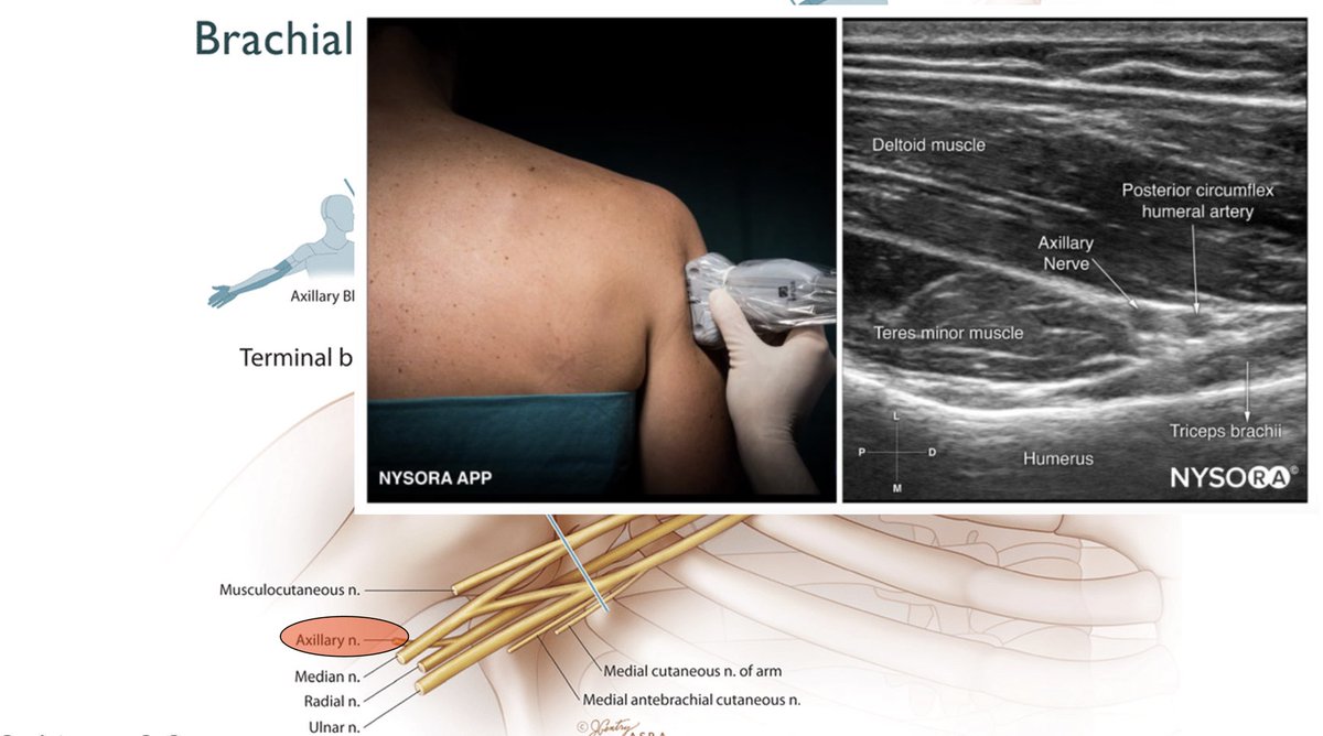 CAS Regional & Acute Pain Section (@cas_reganes) on Twitter photo Nerves to the shoulder and examples of phrenic-sparing blocks of the shoulder presented by <a href="/PatrickWongMD/">Patrick Wong</a> <a href="/OttAnesthesia/">OttawaAnesthesiology</a> #WDRAPM Nerves to the shoulder and examples of phrenic-sparing blocks of the shoulder presented by <a href="/PatrickWongMD/">Patrick Wong</a> <a href="/OttAnesthesia/">OttawaAnesthesiology</a> #WDRAPM