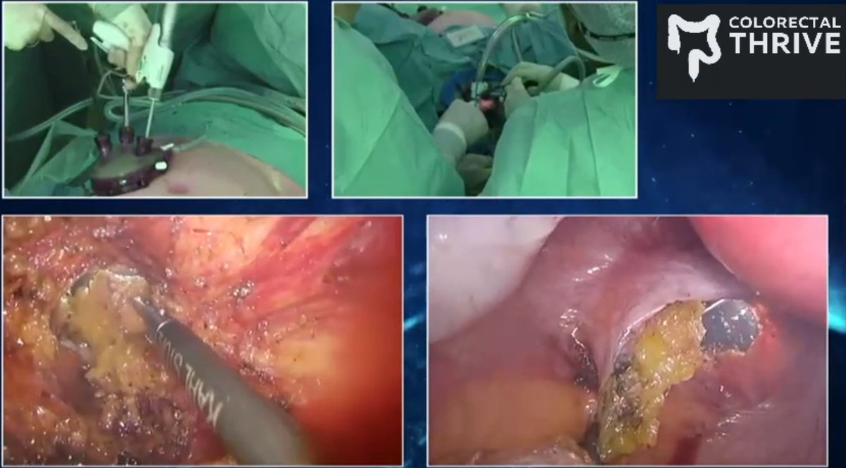 colothrive's tweet photo. At #THRIVE24 we share what we do best! Watch a 2-team transanal #proctectomy with #IPAA by @Wbemelman
https://t.co/FxXxba7Hqb
https://t.co/FYjd2SVfrb Fribourg, Switzerland 14-17.04.2024: 64 Expert Lectures by 40 Stellar Faculty for 27 h of best in class CME - WILL YOU BE THERE ? https://t.co/rY8GynrhSJ