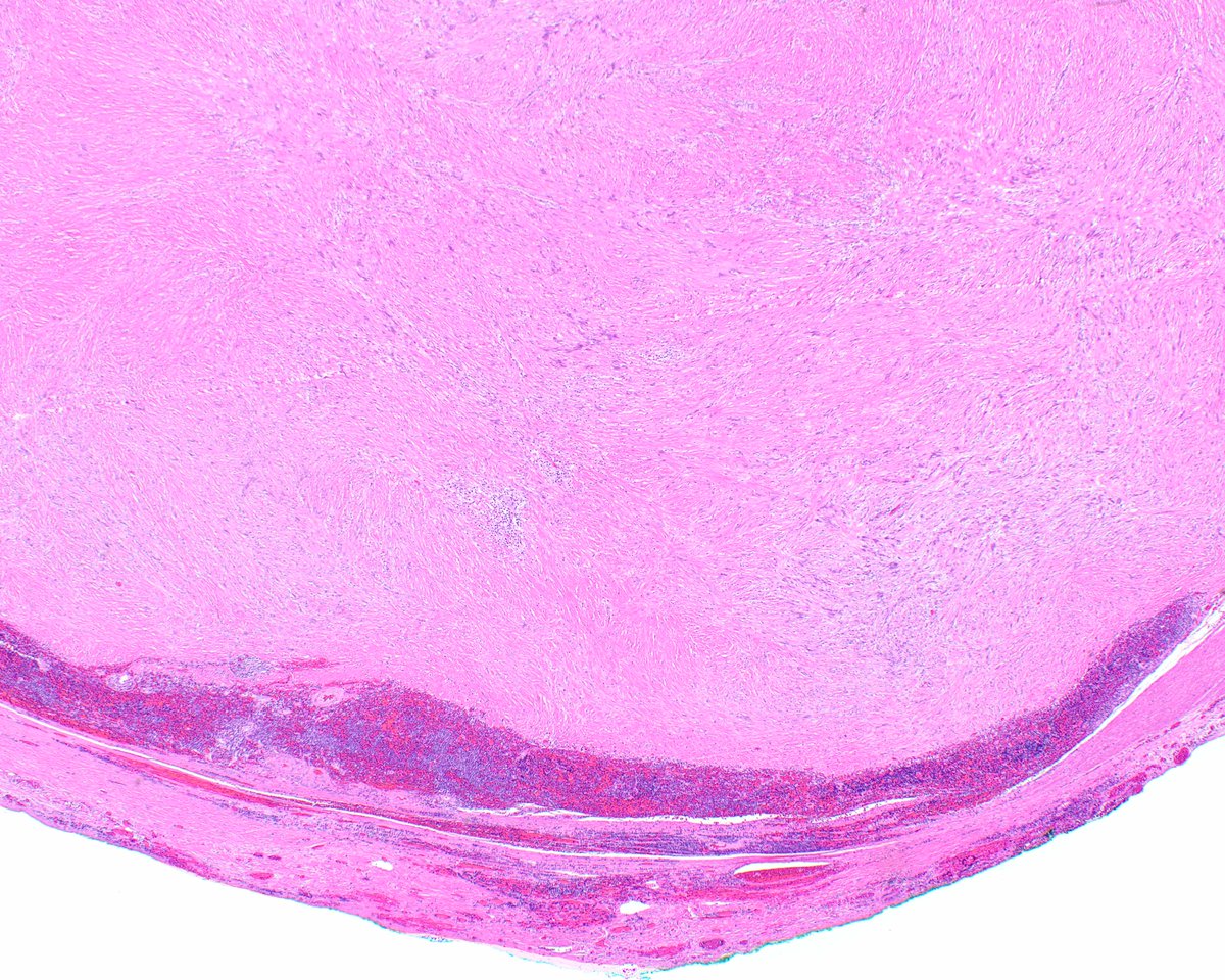 science_press's tweet image. This is a classic gastric schwannoma.  It is centered in the muscularis propria and encircled by a lymphoid cuff. Note the vague nuclear palisading. innovativesciencepress.com