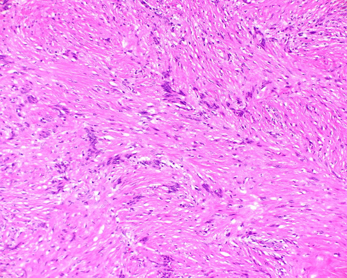 science_press's tweet image. This is a classic gastric schwannoma.  It is centered in the muscularis propria and encircled by a lymphoid cuff. Note the vague nuclear palisading. innovativesciencepress.com