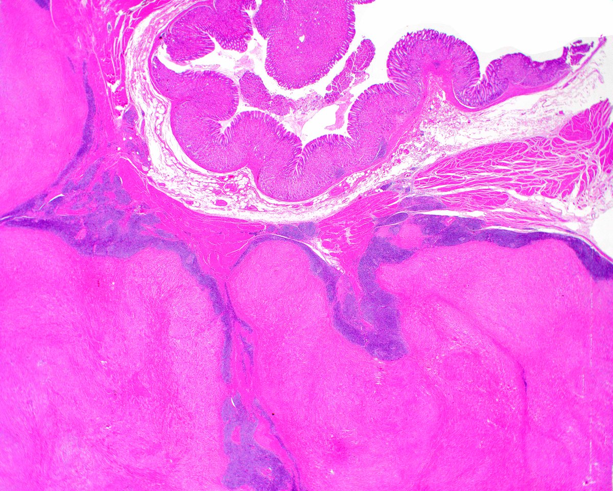 science_press's tweet image. This is a classic gastric schwannoma.  It is centered in the muscularis propria and encircled by a lymphoid cuff. Note the vague nuclear palisading. innovativesciencepress.com