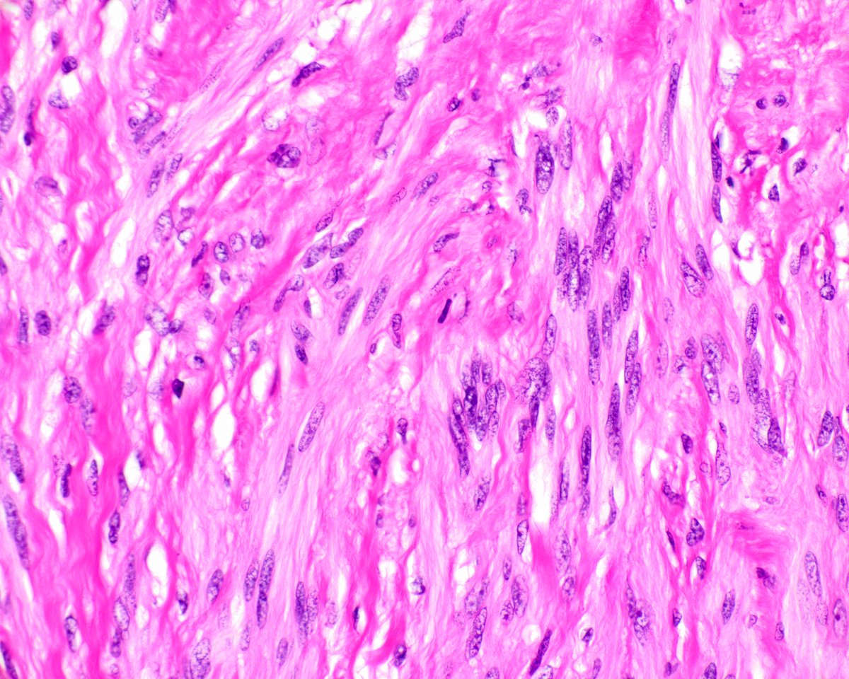 science_press's tweet image. This is a classic gastric schwannoma.  It is centered in the muscularis propria and encircled by a lymphoid cuff. Note the vague nuclear palisading. innovativesciencepress.com