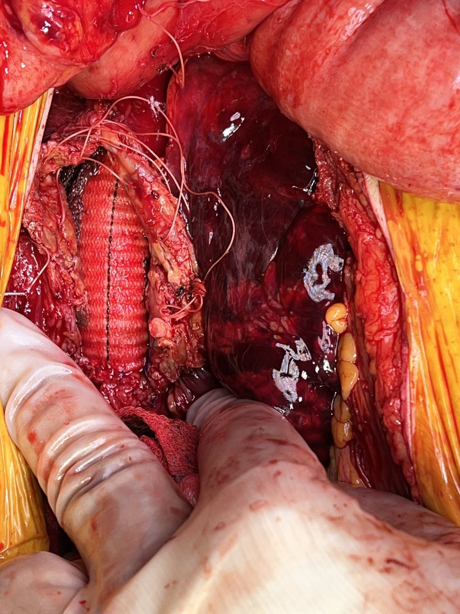 Two ruptured AAA saves in one week.  One endo and one open. <a href="/JEFFAortic/">Jefferson Aortic Center</a> <a href="/JEFFsurgery/">Jefferson Surgery</a> <a href="/JeffersonUniv/">Thomas Jefferson University</a> <a href="/JeffersonVSIG/">Jefferson Vascular Surgery Interest Group</a>