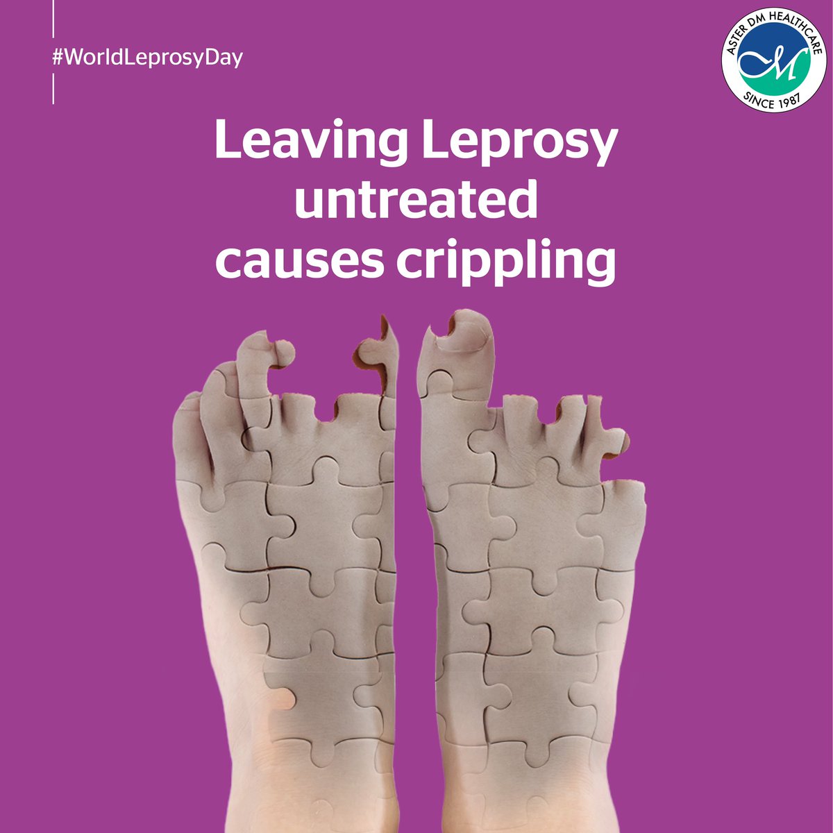 With treatment and prevention being achievable, Leprosy complications still affect people around the world. This #WorldLeprosyDay, let’s together ensure it never happens. As a disease categorised as a ‘neglected tropical disease’, or NTD, it is important to remember that we have…