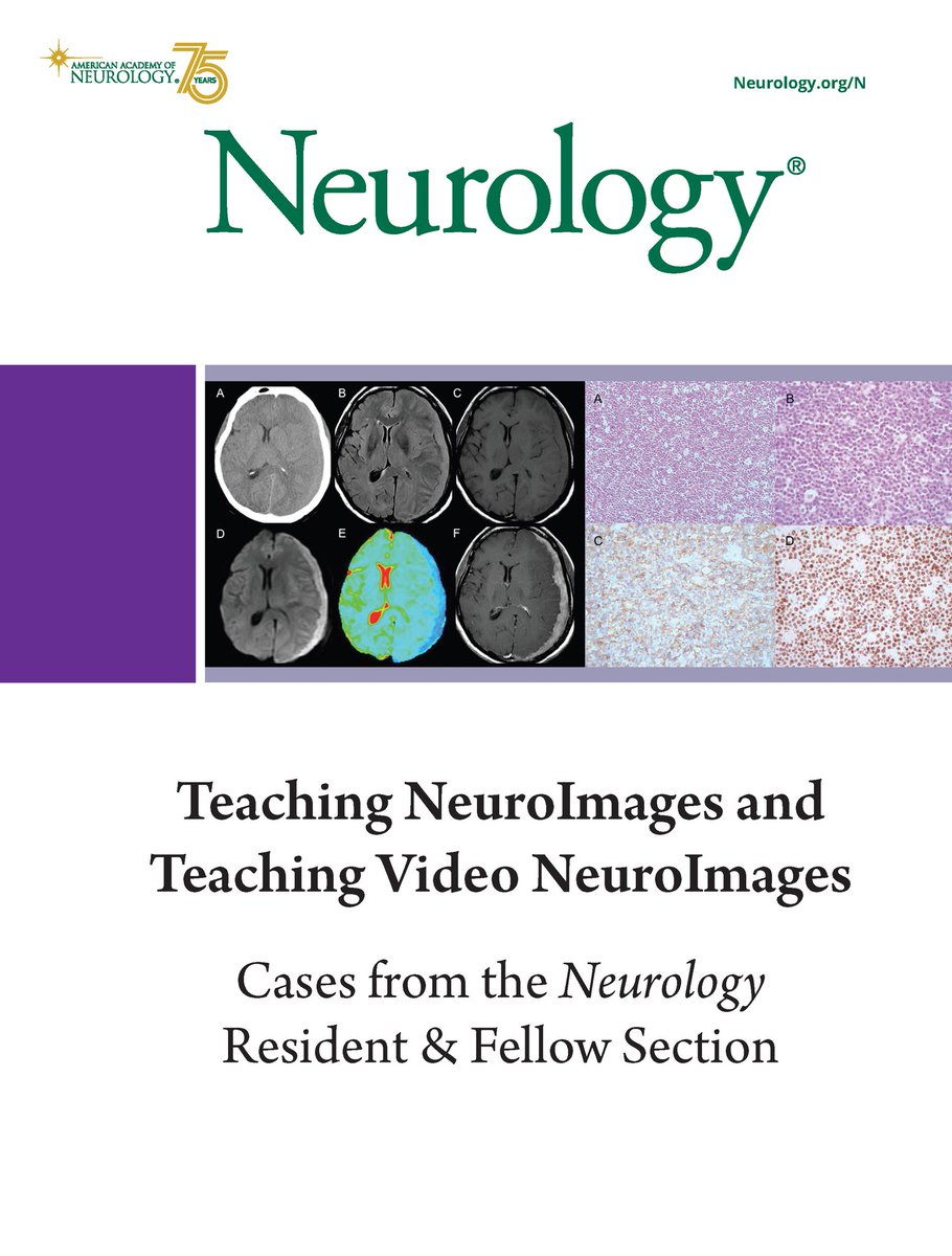 Introducing the Teaching NeuroImage and Teaching Video NeuroImage eBook: Cases from the Neurology® Resident &amp; Fellow Section—a compilation of previously published cases highlighting foundational concepts in clinical neurology. Learn more: bit.ly/48RNNEx

#NeurologyRF