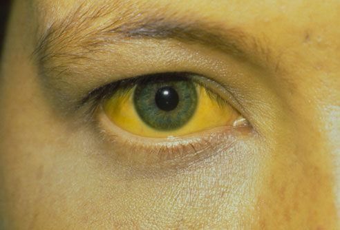 DrMedica_13's tweet image. Clinical Challenge✨👁️.
.
What is the #positive_Finding in this patient? 

What may be the underlying #diseases?

#MedEd #MedX #Diagnosis