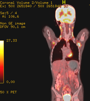 Interim #PET scan of a child with #Hodgkin lymphoma. U can see persistent avid lesions in bilateral axillae and neck. However, surprisingly, the #nuclear med colleague reported a complete response (#CMR)!! Learned a beautiful concept from him when discussed the matter. Any clue?