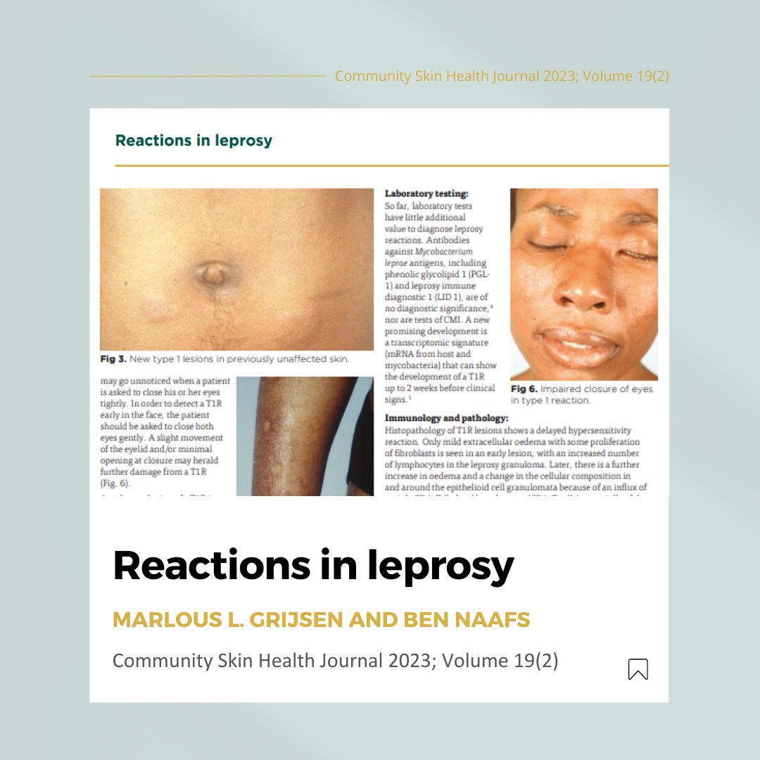 Today on #WorldLeprosyDay we would like to highlight the important article 'Reactions in Leprosy' which was written by Dr Marlous L. Grijsen and Dr Ben Naafs, and published in the most recent issue of the Community Skin Health (CSH) Journal. Full article: bit.ly/CSH-Vol19-2