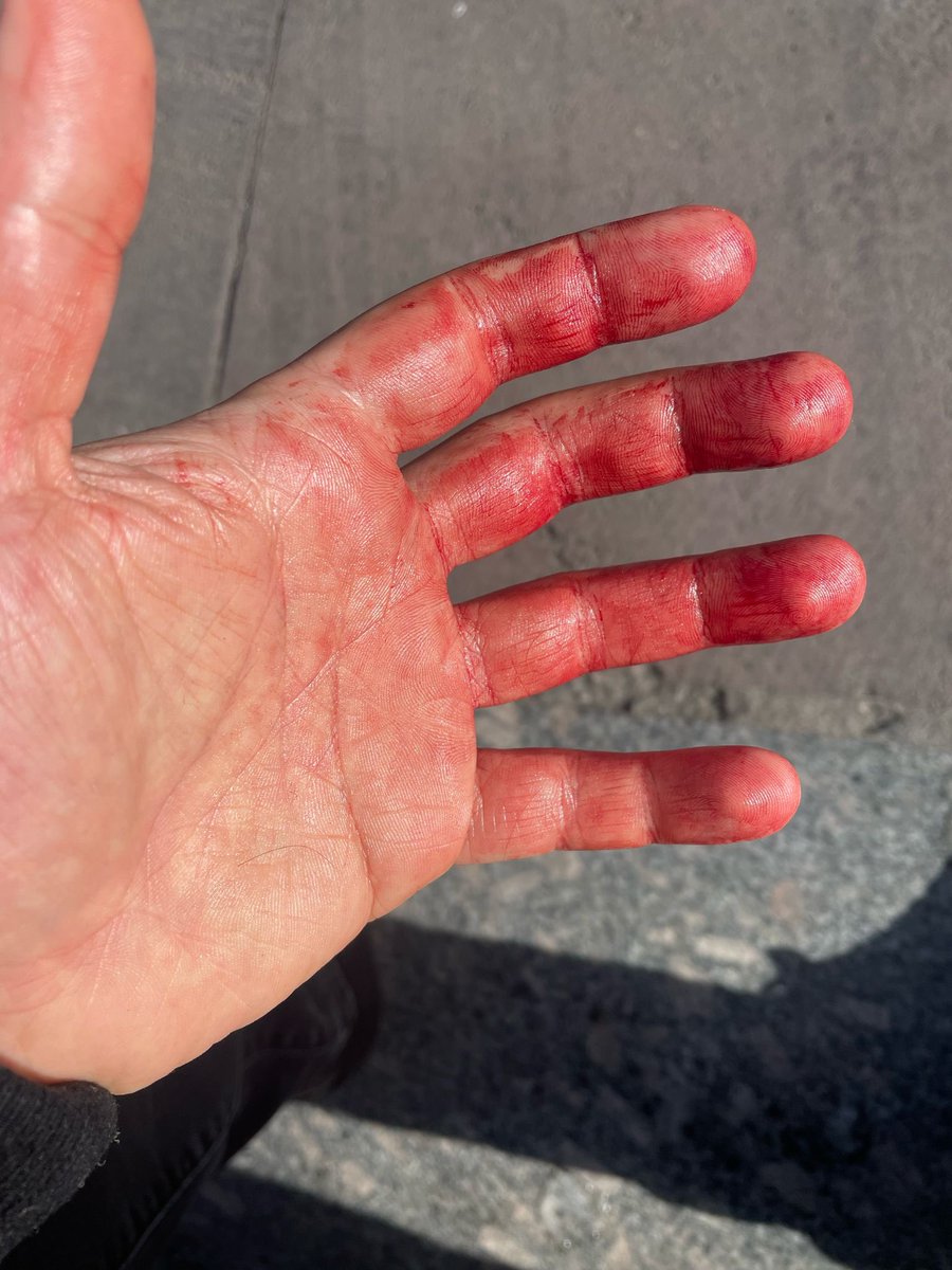 Ankara Genç ODTÜLÜLER Eğitim Kurumu'nda patronlar ödenmeyen ücretini isteyen öğretmenin yüzüne sıcak su attı, kafasında bardak kırdı, yerde tekmeledi.

Denetimsizlik ve patronlara sağlanan her türlü imtiyazın soncu öğretmene işkence oluyor <a href="/tcmeb/">Millî Eğitim Bakanlığı</a>. Öğretmene kalkan eller kırılır!