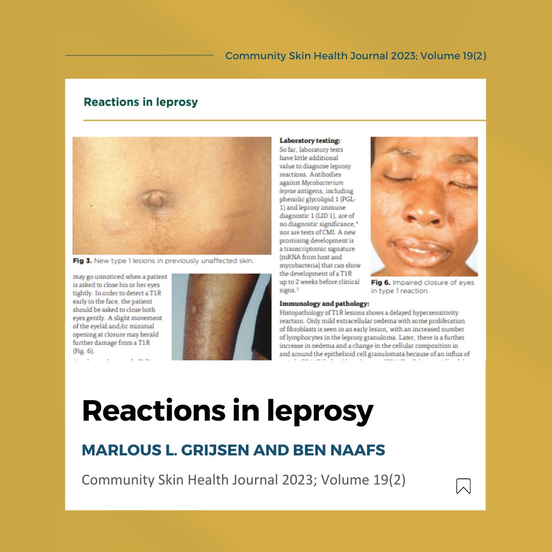 Today on #WorldLeprosyDay we would like to highlight the important article 'Reactions in Leprosy' which was written by Dr Marlous L. Grijsen and Dr Ben Naafs, and published in the most recent issue of the Community Skin Health (CSH) Journal. Full article: bit.ly/CSH-Vol19-2