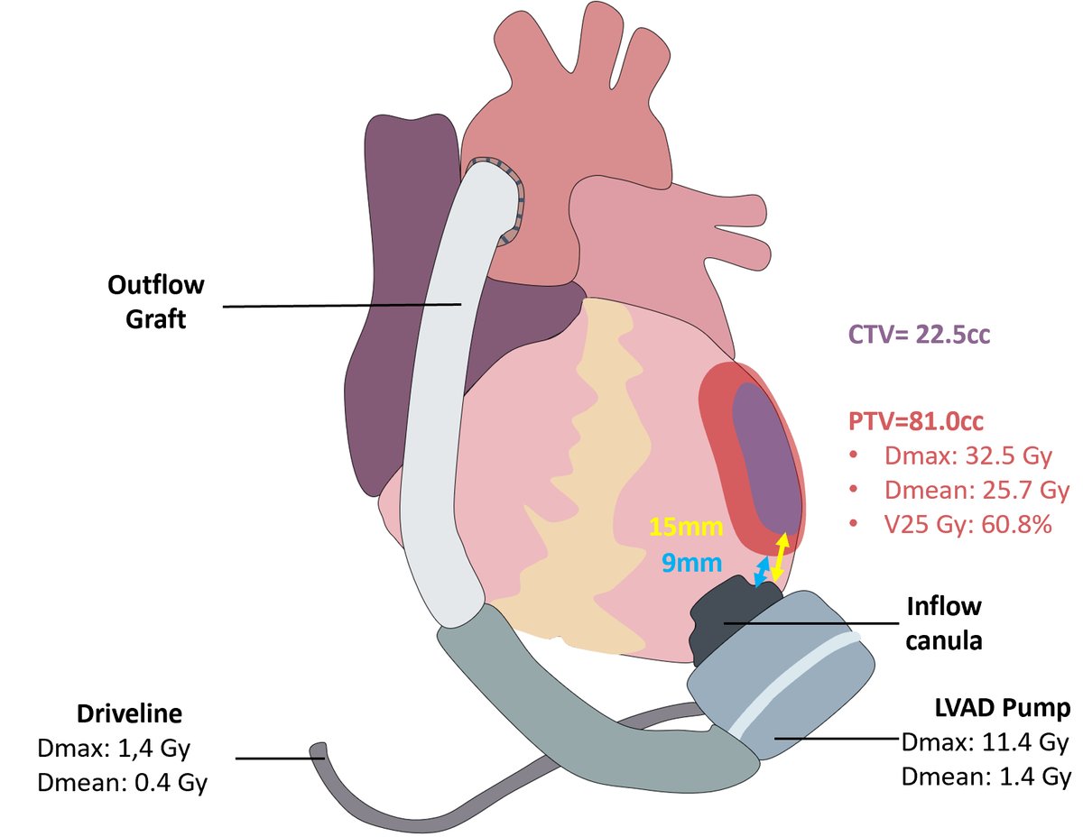 If you were interested in our description of SBRT in #LVAD patients with refractory #VA, @JACCjournal (tinyurl.com/5bjcmbef) -> see our review in @JCardioEP (tinyurl.com/2594dhtb) Great collaboration between @CHUbourgogne, @CHUSainte and @EmoryUniversity!