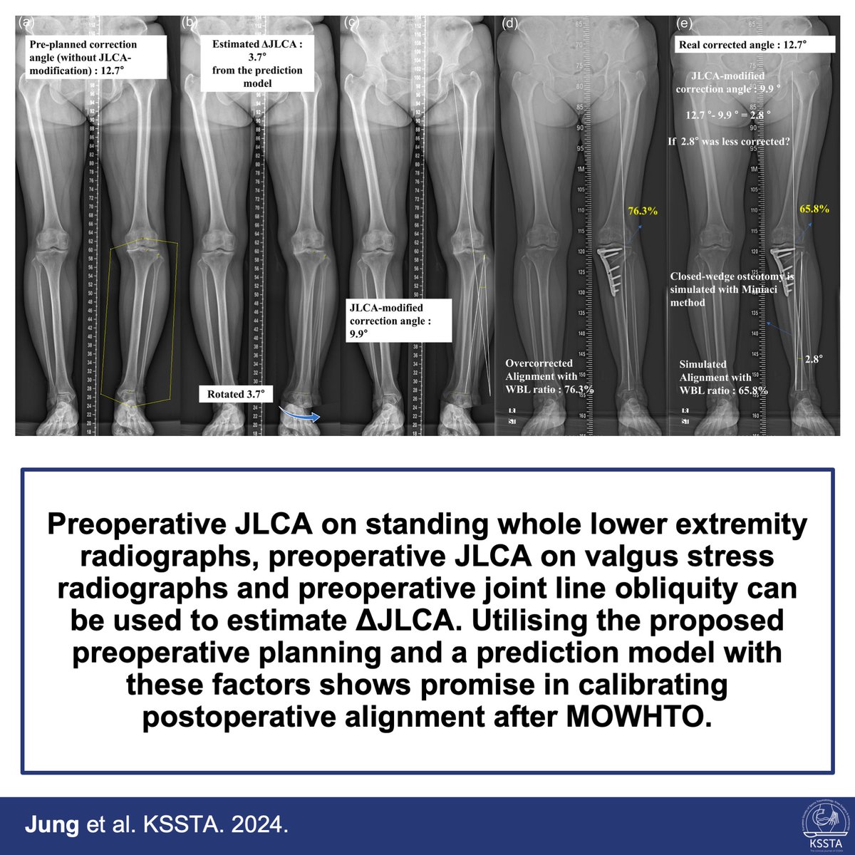 KSSTA's tweet photo. https://t.co/4TYjTPY1uH
Read this recently published study to get new insights into preoperative planning of HTO.
#knee #osteotomy #osteoarthritis #hto #dfo #dlo #jointline #alignment https://t.co/oPhJk6vJeQ