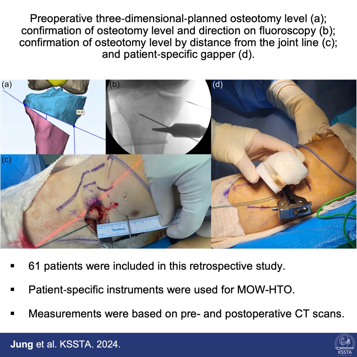 KSSTA's tweet photo. https://t.co/4TYjTPY1uH
Read this recently published study to get new insights into preoperative planning of HTO.
#knee #osteotomy #osteoarthritis #hto #dfo #dlo #jointline #alignment https://t.co/oPhJk6vJeQ