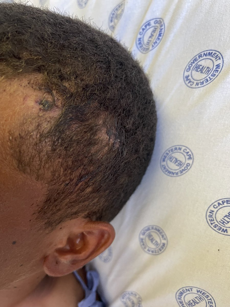 Patient with Hx of bullet scratches his head causing small 1 c.m superficial wound patient is doing well no complains at all conscious, oriented and GCS 15/15 
Skull is intact on examination and no tenderness over the site of the wound