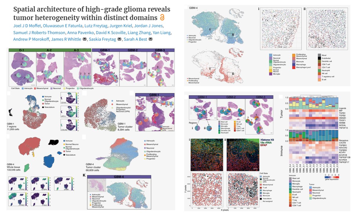 Intratumoral heterogeneity & Immune-tumor cell Zonation in #Glioblastoma Integrative #SpatialTranscriptomics #GeoMx #CosMx #Xenium +public #Visium IDH1-WT tumors have more mesenchymal+progenitor-like cells than IDH1-mutant Couturier for spatial cell type deconvolution #GeoMx…