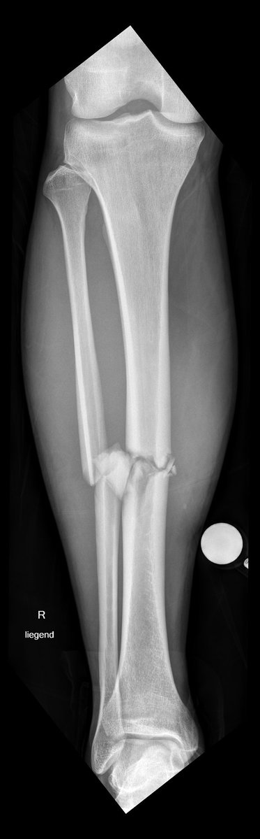 physiotwiss's tweet photo. @MarvinStiebler @Retlouping 1. focused ESWT for late union after osteosynthesis 09/23. Just started, going for 3 sessions over three weeks. 3400 pulses 0.3mJ/mm2; 2. BFRT at 80% LOP with PTS Delphi: calve training, qceps through leg raises etc (30/15/15/15) #Shockwave #bfrt @thebfrpros https://t.co/Ln0np6uIyW