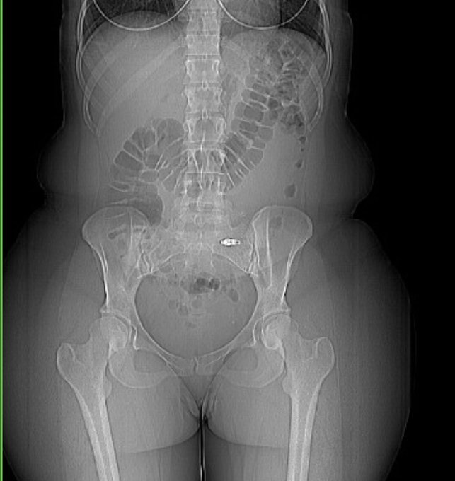 When your thick and your CT shows it 😂🤪 Them hips are &ldquo;fireeeeee&rdquo; https://t.co/LkIQz0Z6aB<a href="/tag/newprofilepic"class="tags"><span>#newprofilepic</span></a>