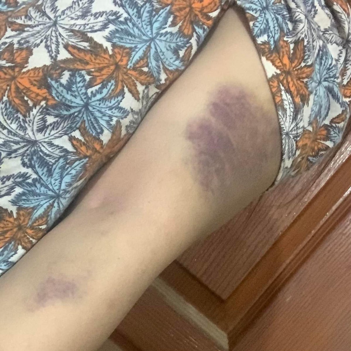 RabiaAnumm's tweet photo. Trigger Warning ‼️ Nomaika , Age 27, this girl is suffering from multiple injuries right now on her entire body, mainly ribs, jaw & face. Every part of her body is badly injured.
She was beaten almost to death by her own husband who is a News anchor and program host. 

According to the girl “on Monday 22nd Jan My husband Ashfaque Satti beat me like an animal while character assassinating me...
He grabbed me from my hair, dragged me across the floor & knocked my head repeatedly against the walls and door.
He sat on my chest trying to choke me multiple times.He put the pillow on my face to stop me from breathing.
He repeatedly said:
"Tumhe Mar Kar Tumhari Laash Gaeb Kar Du Ga.”
"Aaj Tu marray Gi Yaha Mere Hath Sy”

#DomesticAbuse 
#DomesticViolence
