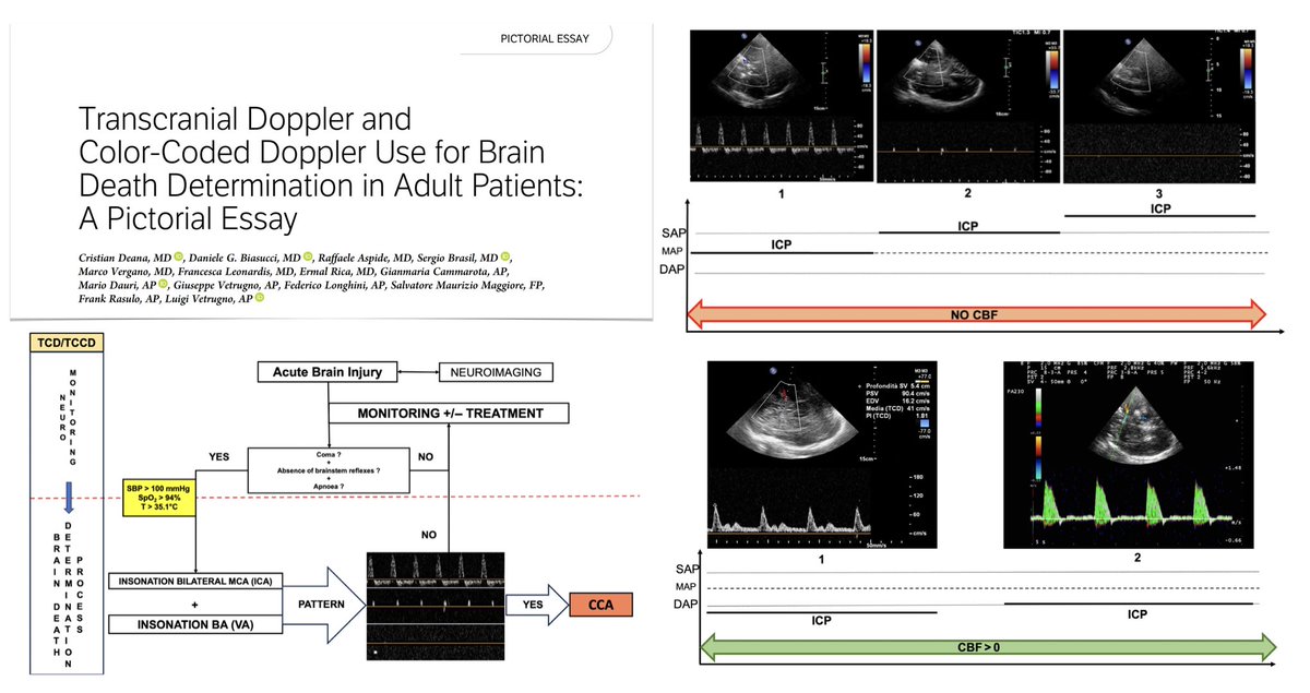 TCD &amp; TCCD in brain death in adults:
🖥️ historical perspective
🖥️ optimize signal acquisition
🖥️ acoustic windows, #ultrasound anatomy &amp; assessment
🖥️ indications/conditions for using for BD
🖥️ pathophysiology of cerebral circulatory arrest &amp; US findings
🖥️ evidence on TCD/TCCD