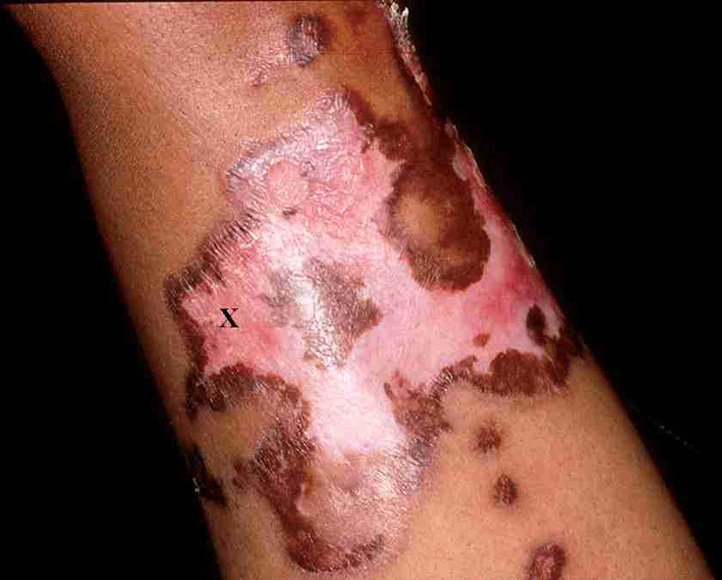 “Cosmetic disfigurement due to scars and dyspigmentation is the main complication of discoid lupus erythematosus. There is another complication of DLE — the risk of keratinocyte carcinoma…” #DermWorld Insights and Inquiries aad.org/dw/dw-insights…