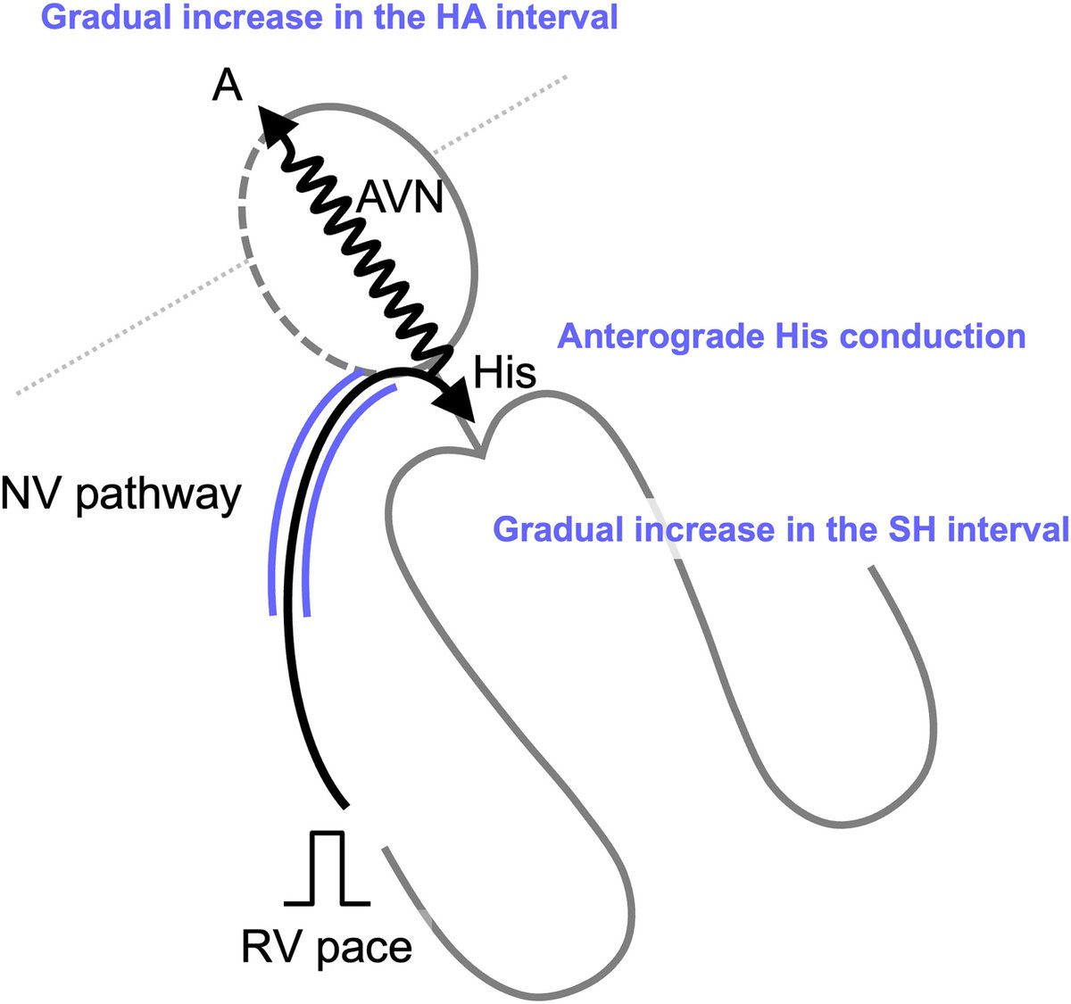 JACCJournals's tweet photo. Coexistence of 2 Mahaim pathways represents a diagnostic challenge. Dr. Soichiro Maeda, et al present a case in which the stimulus-His/His-Atrial intervals were useful for identifying concealed nodoventricular or His-ventricular pathways. https://t.co/zRCxtXVGVg #JACCCaseReports https://t.co/pDtzx8BF4F