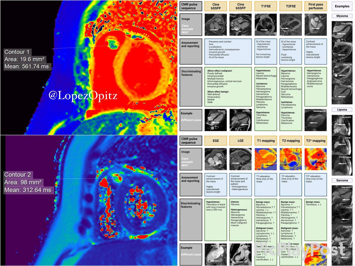 MASS > 1.5T🧲 :
T1 MAP ( 561 ms) / T2 MAP(312 ms)
<a href="/cshenoy3/">Chetan Shenoy</a> <a href="/purviparwani/">Dr. Purvi Parwani</a> <a href="/chiarabd/">C Bucciarelli-Ducci</a> <a href="/DanielVargasMD/">Daniel Vargas, MD</a> <a href="/DrFuisz/">Dr. Anthon Fuisz, MD</a> <a href="/HEARTinMagnet/">Pankaj Garg</a> <a href="/wikimagen/">Pedro Graziano Sanchez</a> <a href="/JordiBroncano/">Jordi Broncano</a> <a href="/eliseovano/">Eliseo Vañó</a> <a href="/josejgdnews/">Jose Juan Gomez</a> <a href="/MasriAhmadMD/">Ahmad Masri</a> <a href="/danilorenzatti/">Daniel Lorenzatti, MD.</a> <a href="/iamritu/">Ritu Thamman MD</a> <a href="/JRodriPalomares/">José F. Rodríguez Palomares</a> <a href="/carpenter_jp/">JP Carpenter</a> <a href="/JoaoLCavalcante/">João Cavalcante</a> <a href="/vineetao17/">Vineeta Ojha</a>