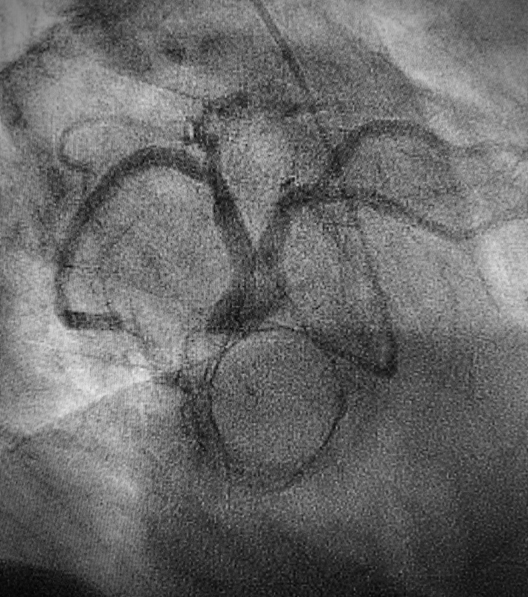 #STEMI in post-TAVR patient w/ #CorValve Evolut PRO+ 😬 Coronaries usually accessed through side struts of this #TAVR valve (see ref below) ➡️ But in this case, enough room to go around valve (29 mm valve, 39 mm root, 44 mm ascending aorta) ncbi.nlm.nih.gov/pmc/articles/P…