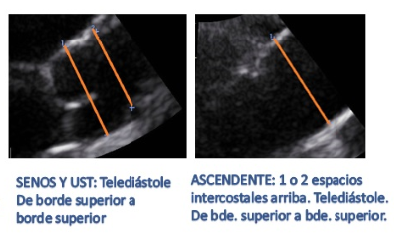 Celeste Carrero (@carreroceleste) on Twitter photo 1) Ser preciso con el sitio que mido e informar la medición de cada región:
-Senos de Valsalva
-Unión sinotubular
-Aorta ascendente (<a href="/EchofirstB/">Echofirst Bot</a> hay que buscarla un espacio IC ⬆️ y tb en vista PE derecha) 1) Ser preciso con el sitio que mido e informar la medición de cada región:
-Senos de Valsalva
-Unión sinotubular
-Aorta ascendente (<a href="/EchofirstB/">Echofirst Bot</a> hay que buscarla un espacio IC ⬆️ y tb en vista PE derecha)