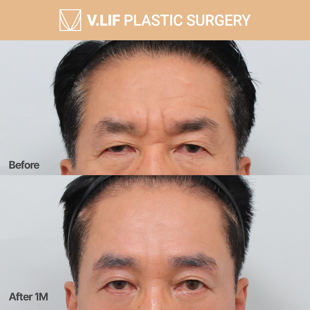 Vlif male #foreheadlift ✨ for natural, but definite results!

#excessskin #foreheadwrinkles #maleplasticsurgery
