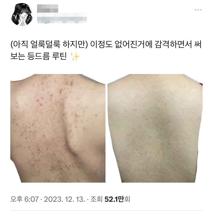ccxxnks1's tweet photo. 등드름 루틴 타래 https://t.co/OYd20veaYS