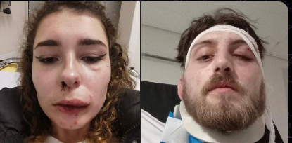 A French couple was attacked by a gang of North Africans last week in Toulouse. The gang made remarks to the girl and when her boyfriend stepped in they attacked both of them, the man has a fractured eye socket and the girl has missing teeth and bruises.