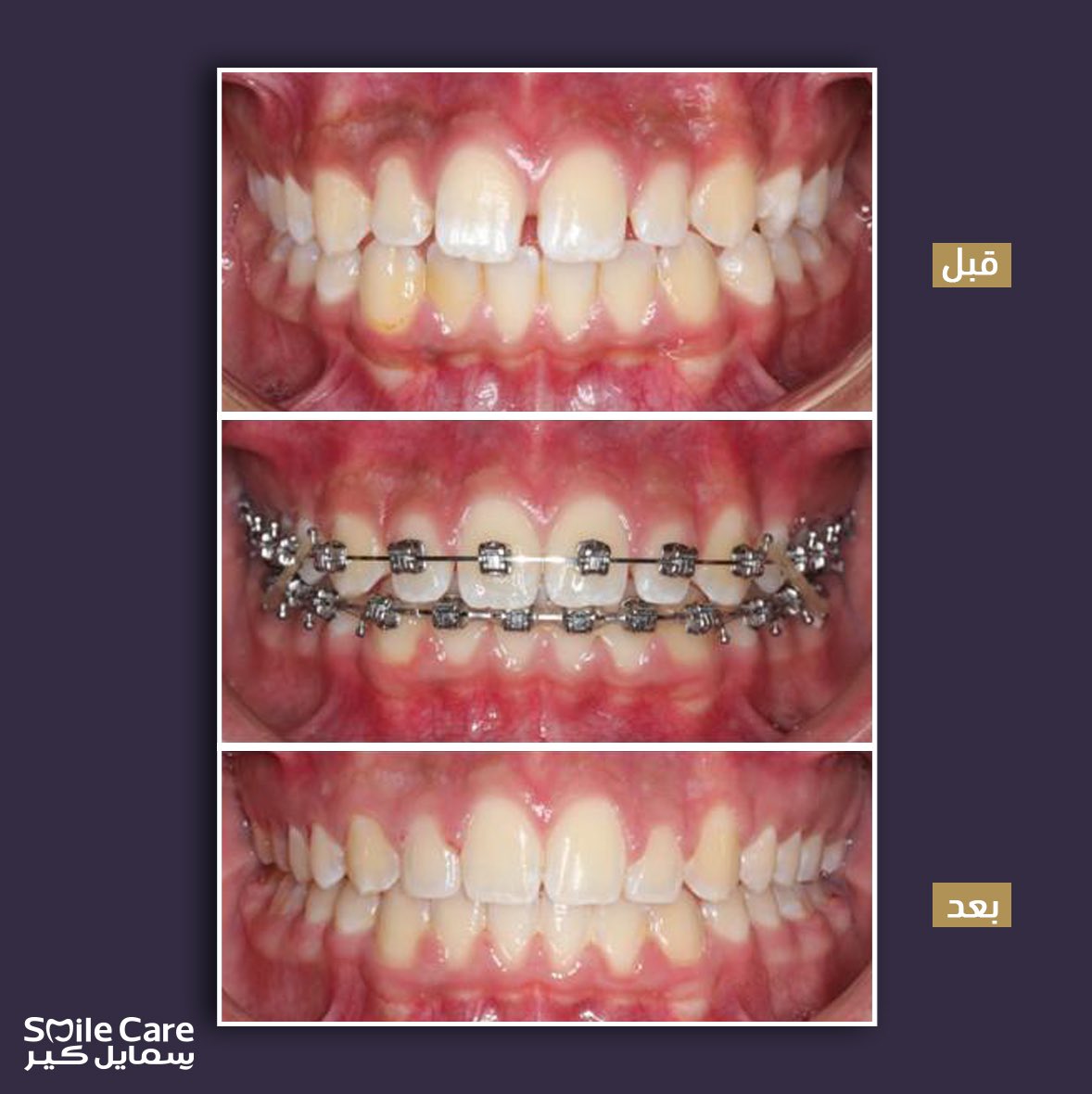بعد ما شفت نتيجة د.محمد السالم 
 أكيد تحمست ترتب أسنانك!
الحالة لمراجع كان يرغب بإغلاق الفراغات بين الأسنان 
وتم العلاج باستخدام التقويم المعدني مع بعض الحشوات التجميلية لزيادة حجم الأسنان 🪄
لمدة ١٤ شهر حتى وصلنا لهذي النتيجة ⌛️👌🏻
للحجز او الاستفسار 
920008774

#عيادة_اسنان