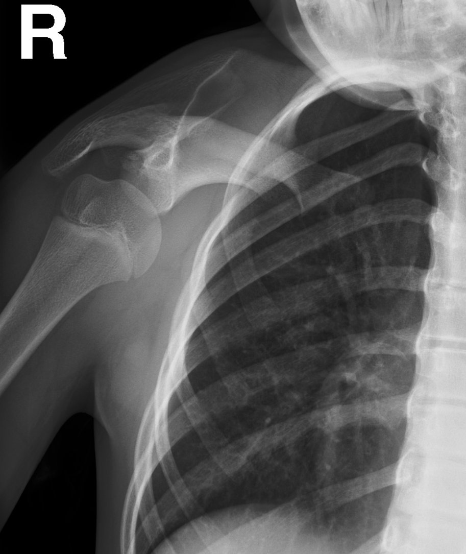 UW_MSKrad's tweet photo. #CaseOfTheWeek‼️🥳‼️
☢️🩻☠️Case#3☠️🩻☢️
#2Parts: What's this entity called in the shoulder radiograph❔❓❔ What syndrome does the patient have❓❔❓
✨Bonus✨: cervical spine sign❓
#FOAMrad #RadEd #MedEd #OrthoEd #OrthoTwitter @ssr_rwg @UWRadRes @POSNA_org https://t.co/DuEUHEAzdT