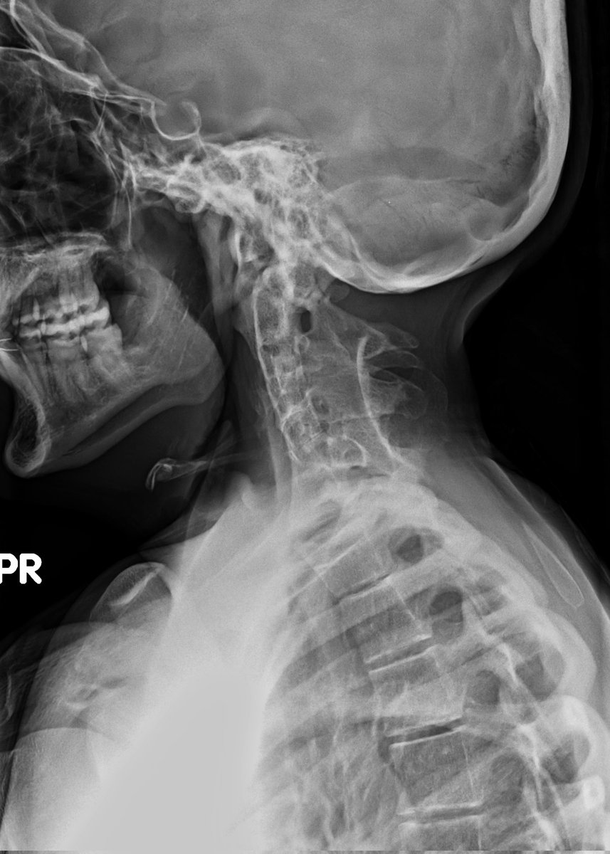 UW_MSKrad's tweet photo. #CaseOfTheWeek‼️🥳‼️
☢️🩻☠️Case#3☠️🩻☢️
#2Parts: What's this entity called in the shoulder radiograph❔❓❔ What syndrome does the patient have❓❔❓
✨Bonus✨: cervical spine sign❓
#FOAMrad #RadEd #MedEd #OrthoEd #OrthoTwitter @ssr_rwg @UWRadRes @POSNA_org https://t.co/DuEUHEAzdT