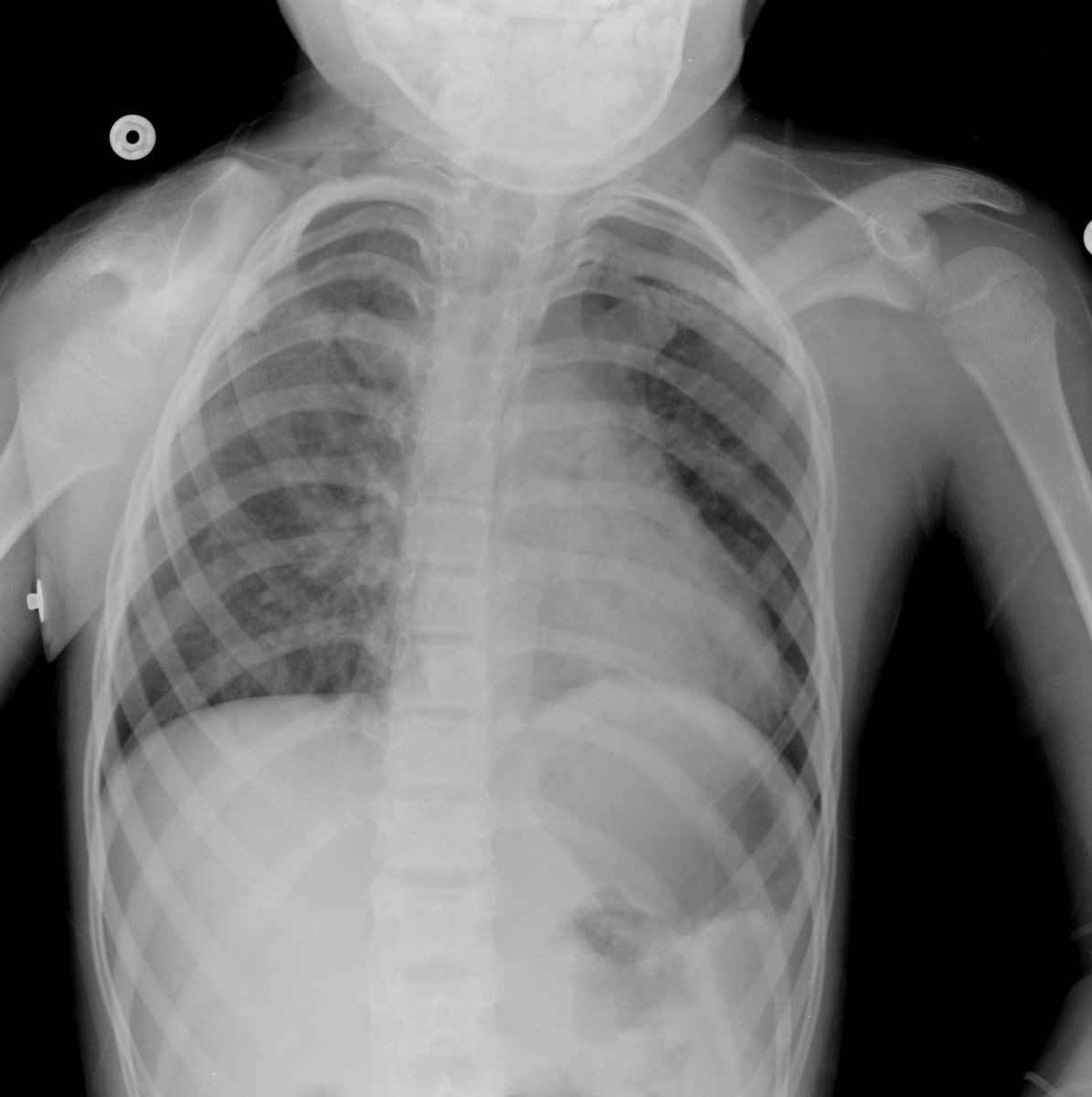 UW_MSKrad's tweet photo. #CaseOfTheWeek‼️🥳‼️
☢️🩻☠️Case#3☠️🩻☢️
#2Parts: What's this entity called in the shoulder radiograph❔❓❔ What syndrome does the patient have❓❔❓
✨Bonus✨: cervical spine sign❓
#FOAMrad #RadEd #MedEd #OrthoEd #OrthoTwitter @ssr_rwg @UWRadRes @POSNA_org https://t.co/DuEUHEAzdT