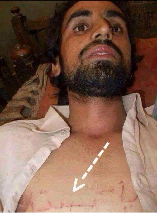 alinawaz_mazari's tweet photo. بلوچ نوجوانوں کو اغوا اور ان پر حیوانوں کی طرح تشدد اور انکے سینوں پر پاکستان زندہ باد لکھ کر پاکستانی فوج اپنی طرف سے بہت بڑا تیر مارتی ہے لیکن اس طرح کی حرکتوں سے پاکستانی فوج سے نفرت میں مزید اضافہ ھوجاتا ہے اور سینوں میں نفرت کی آگ مزید بھڑکتی ہے https://t.co/ihRtdEuKHM