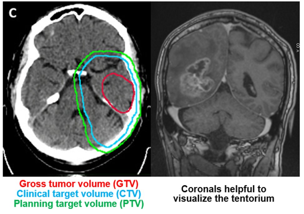 Examples of target volume delineation errors for GBM, some egregious
A common error: crossing the tent with a supratentorial tumor, refer to coronals to help prevent this 
sciencedirect.com/science/articl…