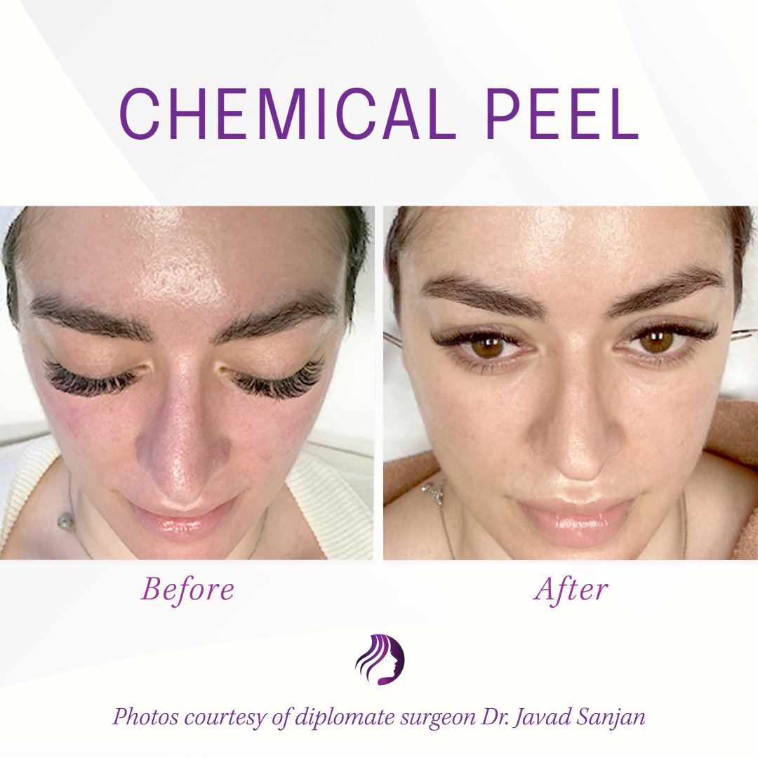 ABFCSorg's tweet photo. This patient's #ChemicalPeel targeted skin tone &amp; texture, minimizing redness &amp; smoothing the skin. Her results are thanks to diplomate Dr. Javad Sajan of Allure Esthetic located in Seattle, Washington. https://t.co/7PUXN9F9VD