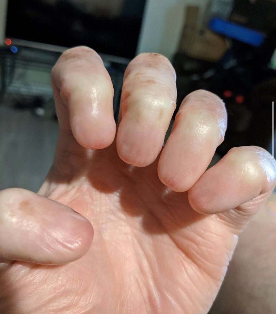 Anonychia is the absence of one or more nails on the fingers or toes. In extremely rare cases, the patient may be missing all of their nails.