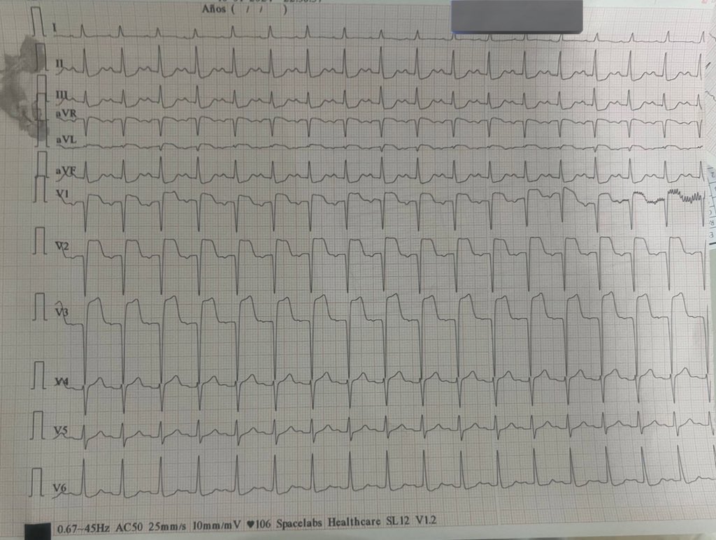 MiniCaso 2: paciente de 40 años, antecedentes de VAo bicúspide con Bentall de Bono en 2007, ReBentall en 2023. Evoluciona con endocarditis fungica y actualmente se realiza 3era reesternotomia y re Bentall. Se recibe al paciente en la sala de RCV y este es el ECG.